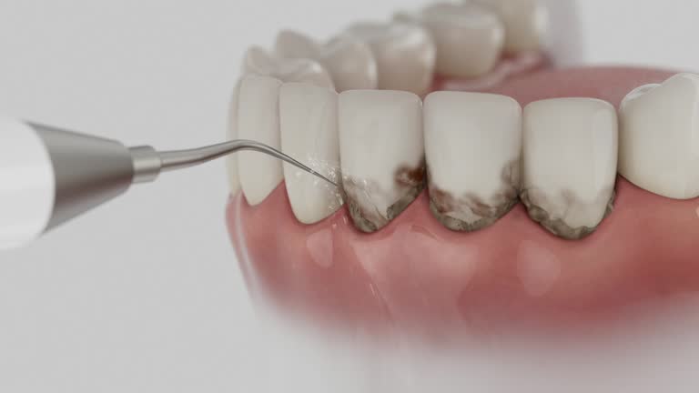 Trusted Wisdom Tooth Removal service in Peppermill Village, MD - Dentist Open Now